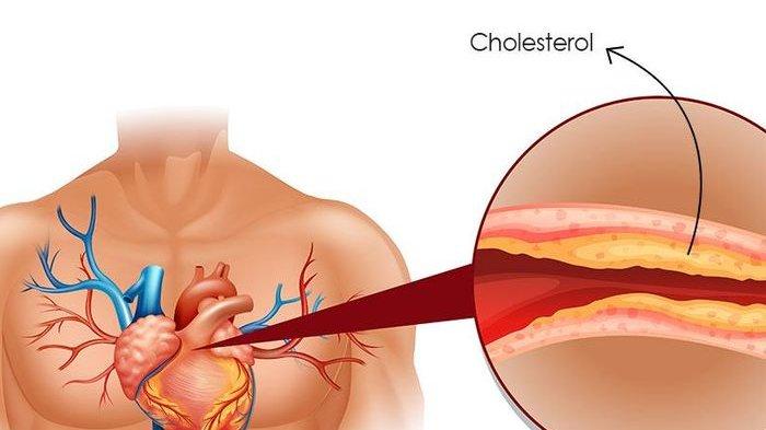Penyebab, Gejala dan Faktor Resiko Kolestrol Tinggi